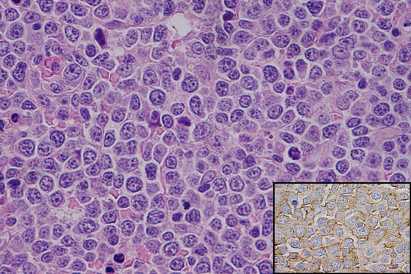 Diffuse Large B Cell Lymphoma